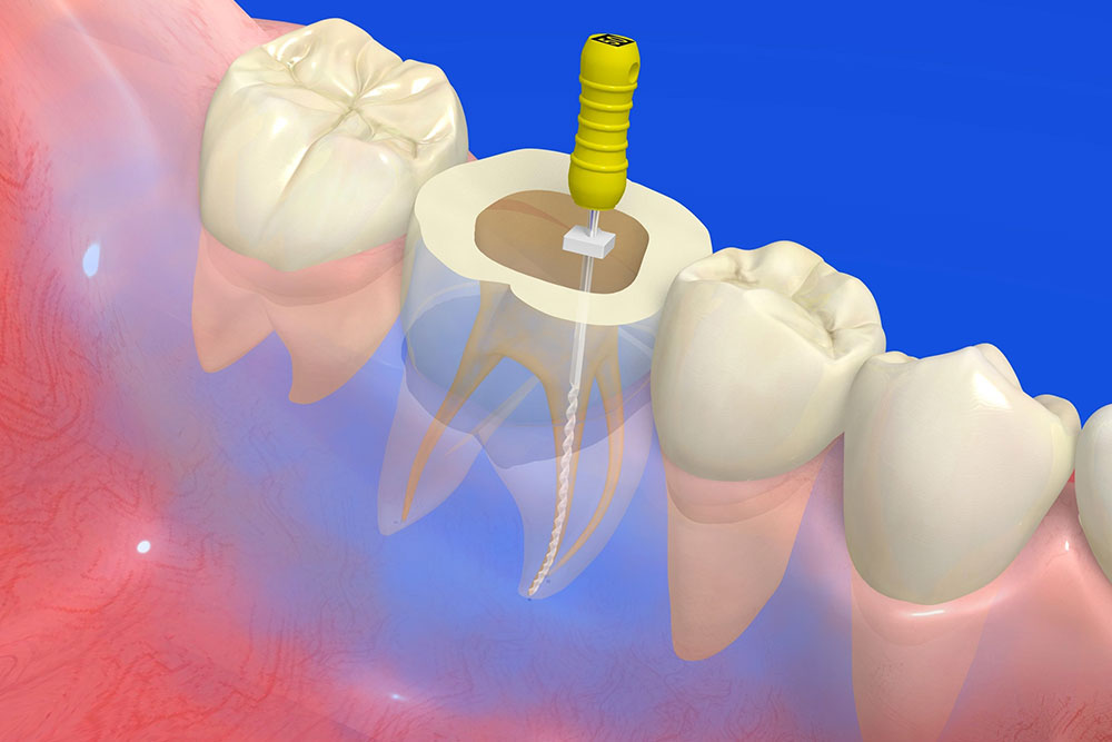 根管治療とは