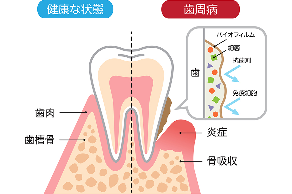 歯周病治療