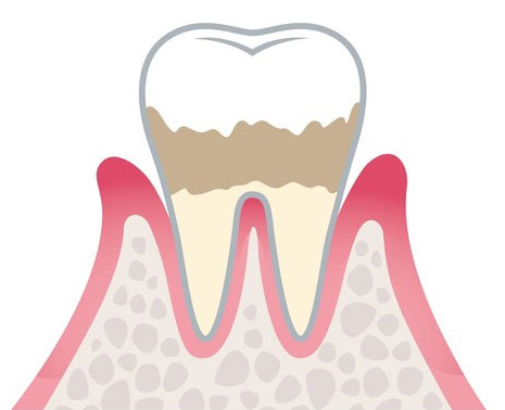 軽度歯周病